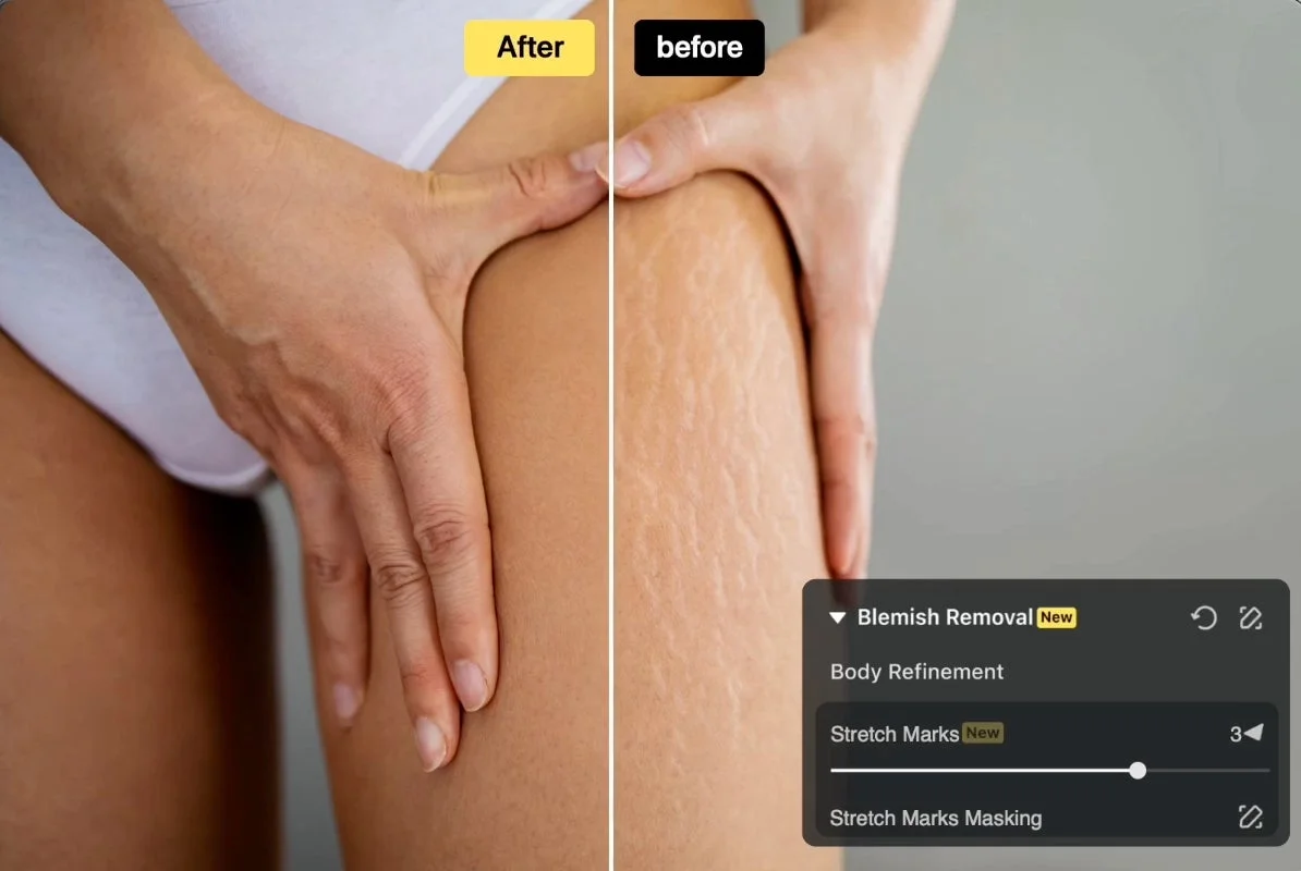 身体の肉割れ除去